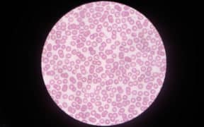 corona effect red blood cells